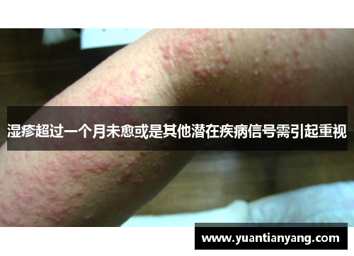 湿疹超过一个月未愈或是其他潜在疾病信号需引起重视